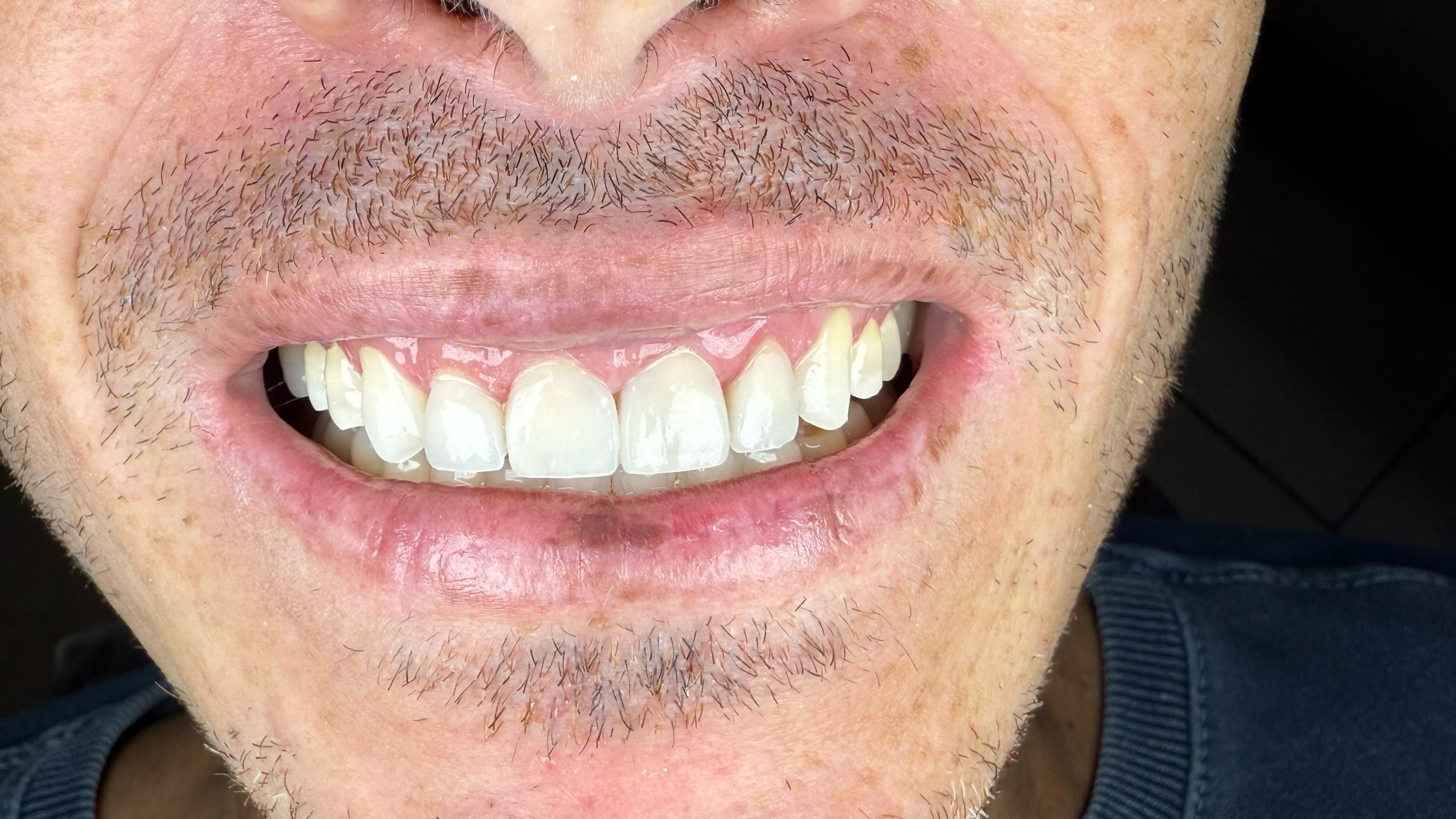 Depois do tratamento